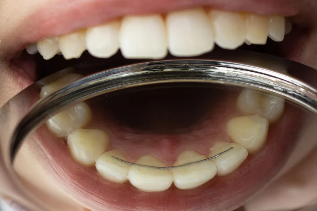 orthodontie gisors contention fil fixe Orthodontie adolescent Dr Luca MANGIARACINA - Orthodontie Gisors