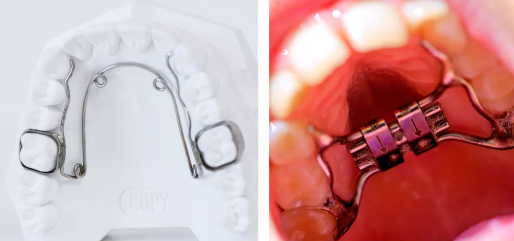 orthodontie gisors enfant disjoncteur quad helix Orthodontie enfant Dr Luca MANGIARACINA - Orthodontie Gisors