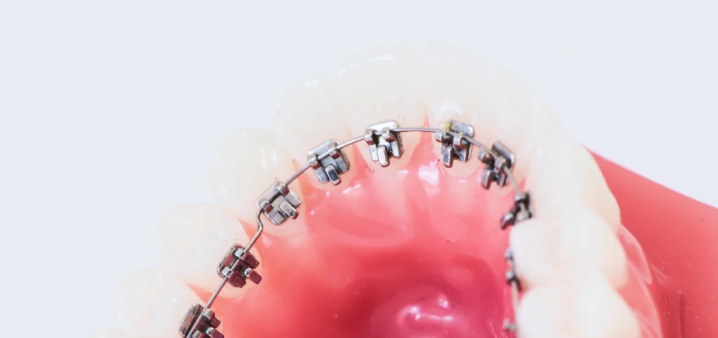 orthodontie linguale gisors orthodontie linguale gisors Orthodontie adulte Dr Luca MANGIARACINA - Orthodontie Gisors