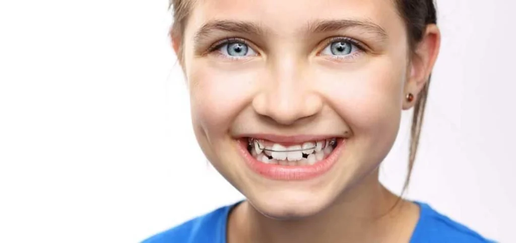 plaque palatine orthodontie gisors Orthodontie enfant Dr Luca MANGIARACINA - Orthodontie Gisors